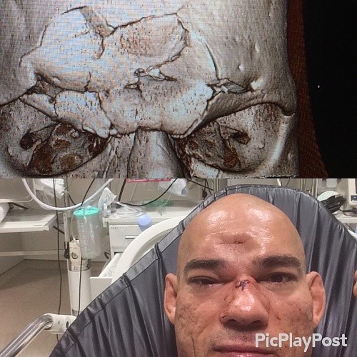 Кадр дня: Ужасная травма "Киборга" Сантоса, полученная в бою с Майклом Пейджем