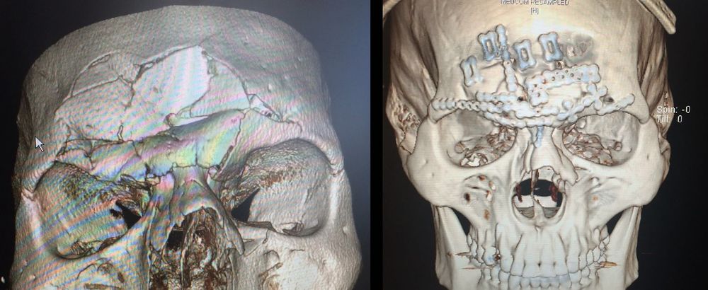 cyborg_before_after_ct.0.jpg